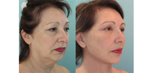 5 Point Face Lift Treatment in London