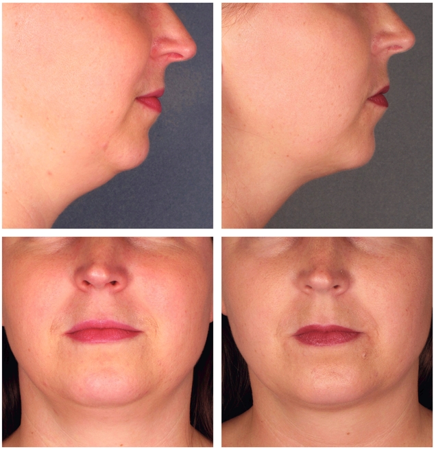 Belkyra ® / Kybella ® Fat dissolving injections in London