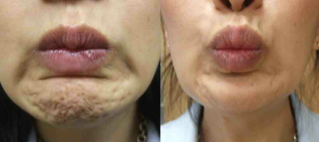 Chin Dimpling Treatment in London