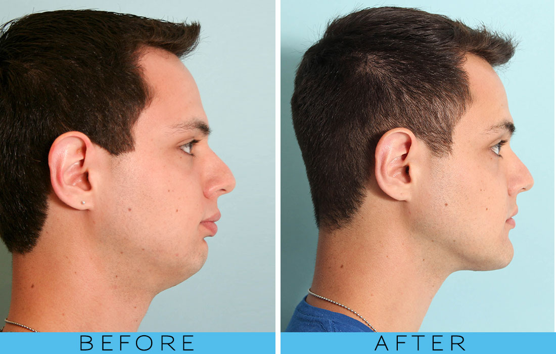 Chin Reshaping Treatment in London
