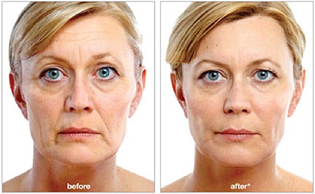 8 Point Face Lift Treatment in London