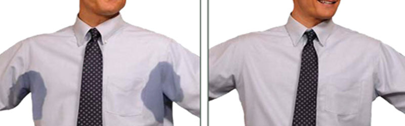 Excessive sweating (Hyperhidrosis) Treatment in London