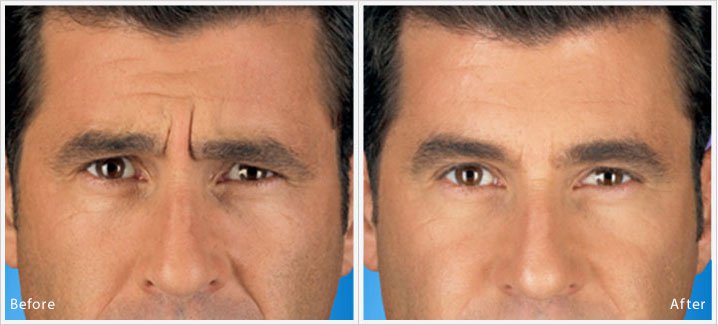 Frown Lines Treatment in London