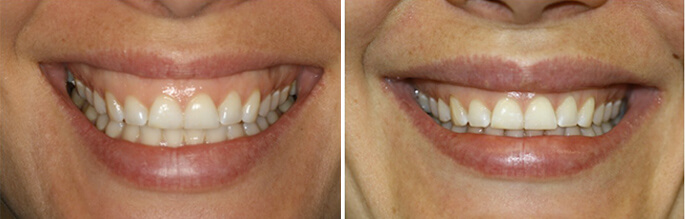 Gummy Smile Treatment in London