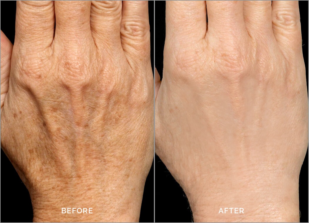 Hand Rejuvenation Treatment in London