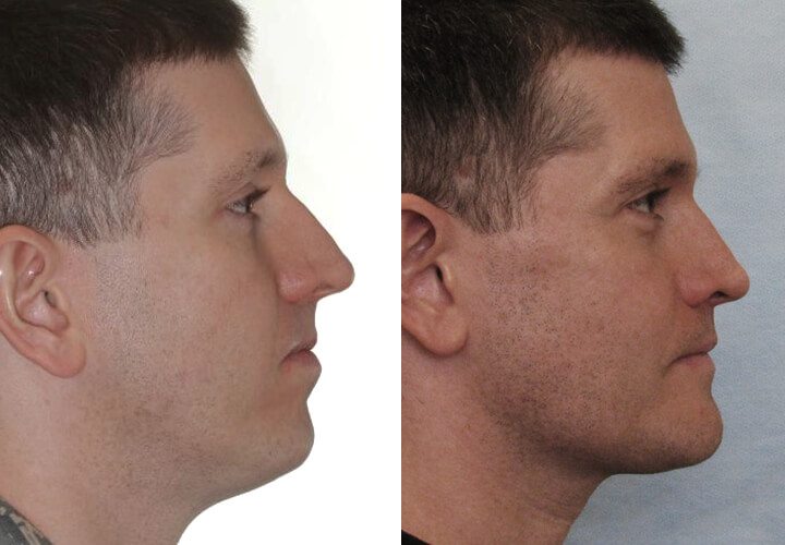 CHIN AND JAWLINE CONTOURING IN LONDON