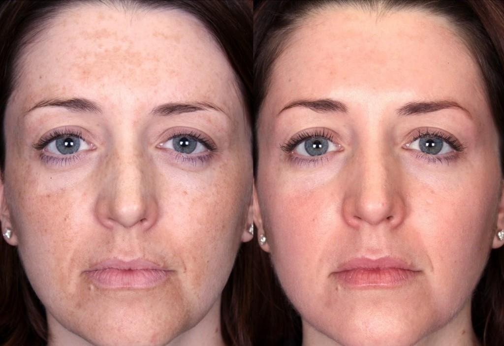 Melasma Chloasma in London