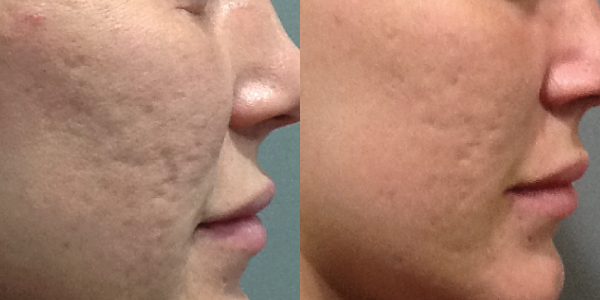 Microneedling Treatment in London