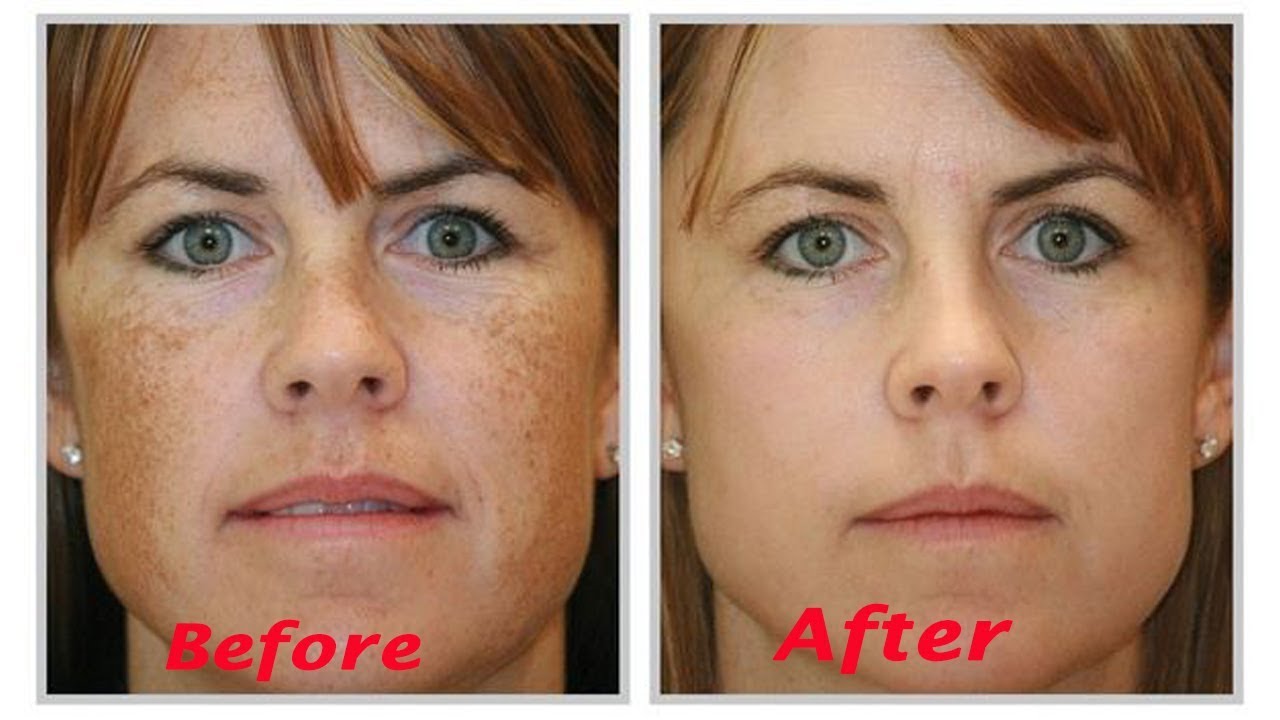 Age Spots Treatment in London