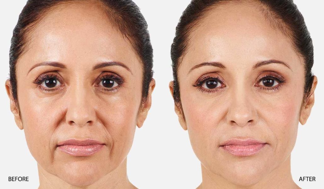 Nasolabial Folds Treatment in London