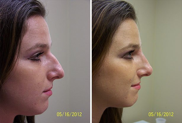 Non-Surgical Rhinoplasty in London