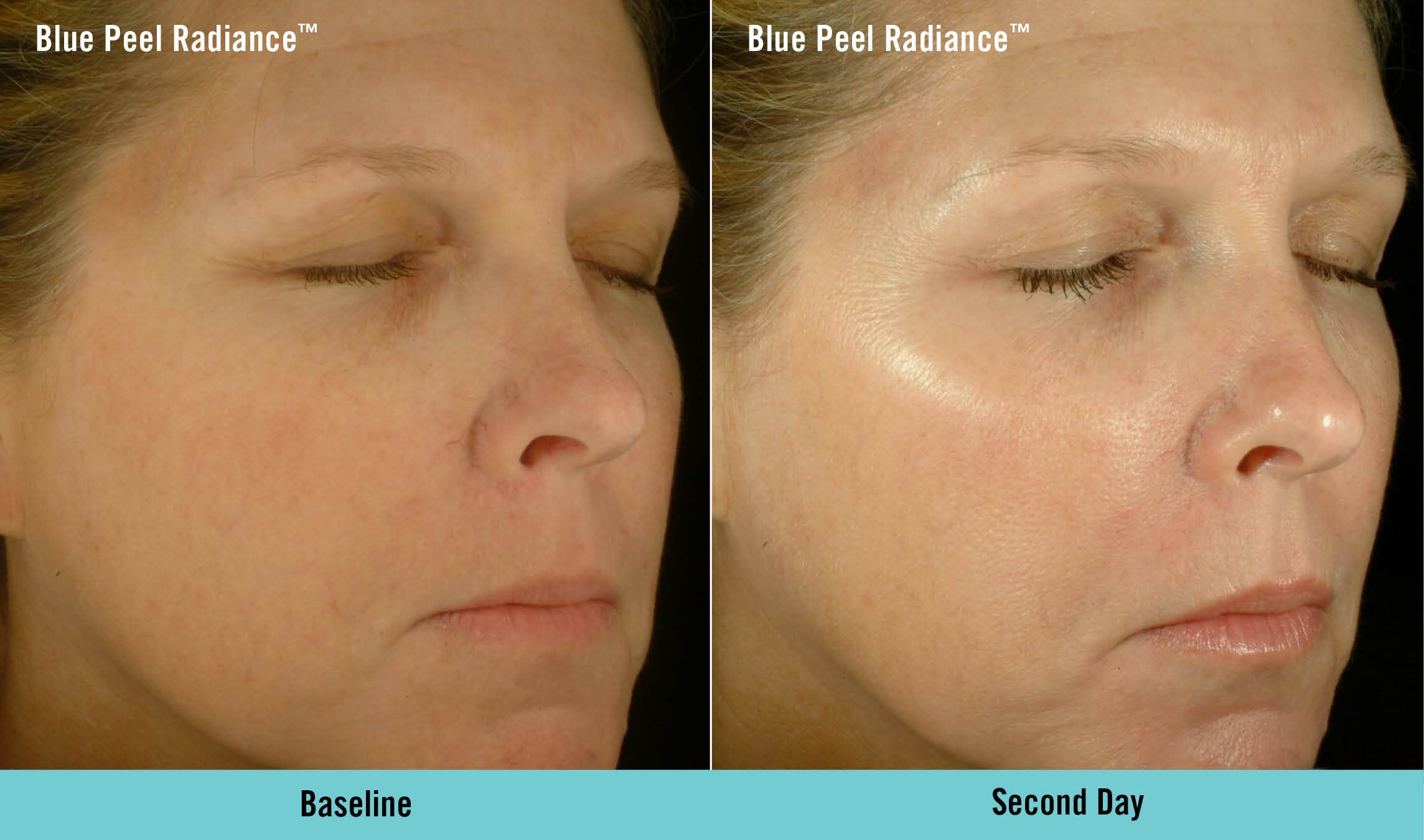 Obagi Blue Peel Treatment in London