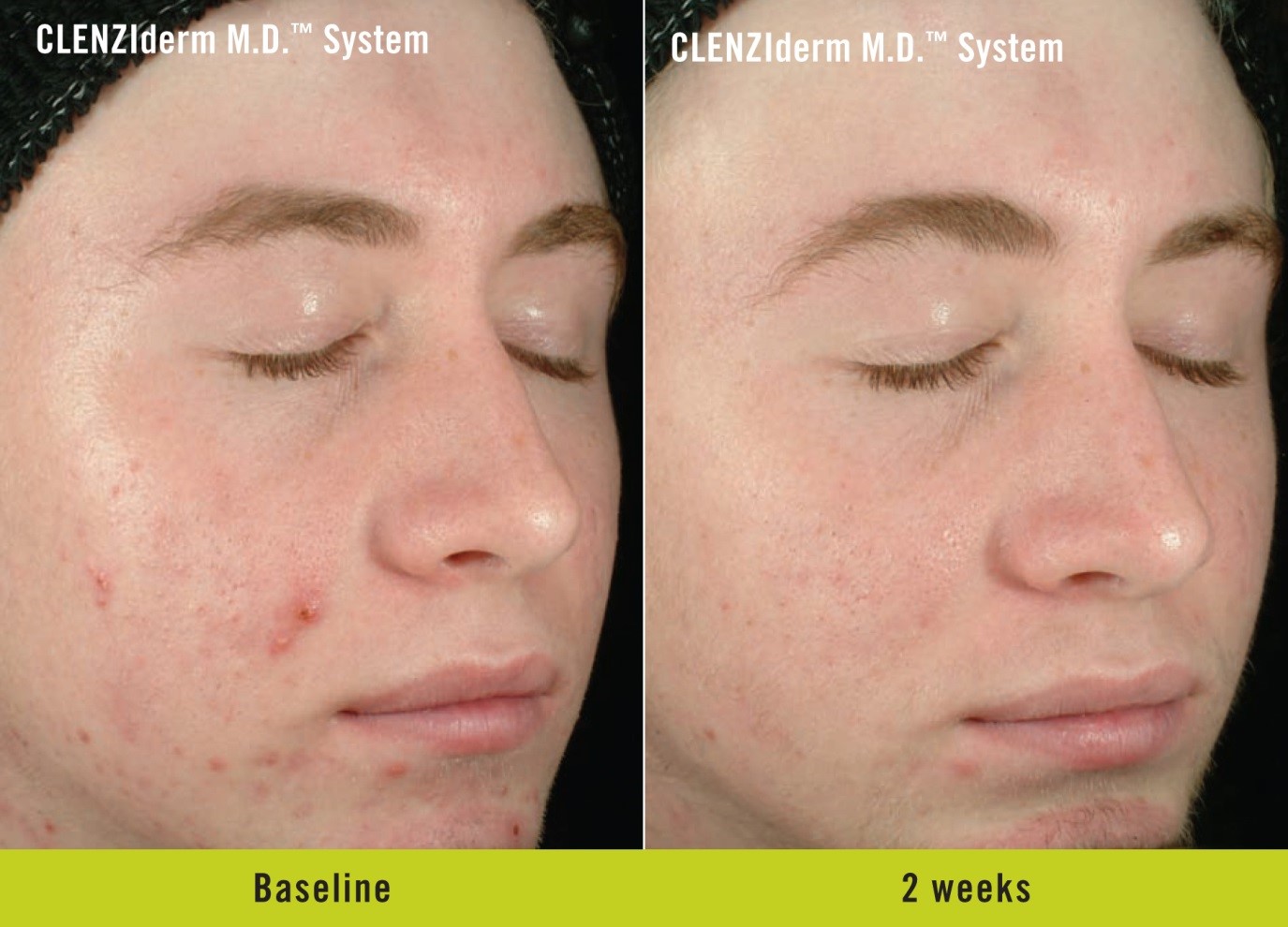 Obagi CLENZIderm M.D. System in London