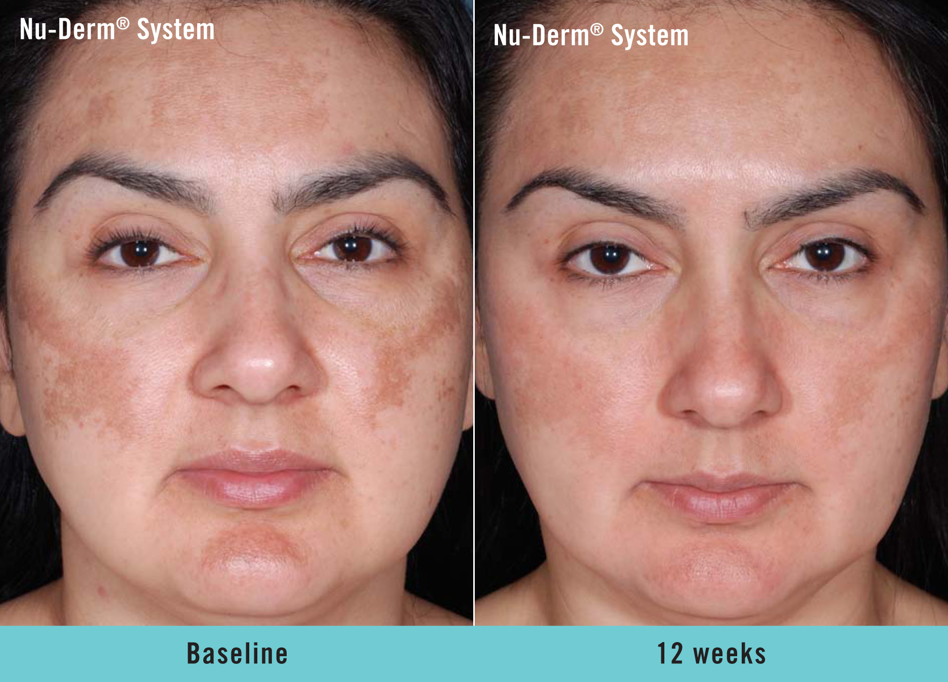 Obagi Nu-Derm System in London