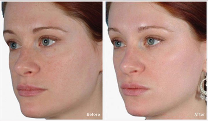 Pigmentation Treatment in London