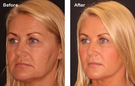 SILHOUETTE SOFT THREAD LIFT IN LONDON