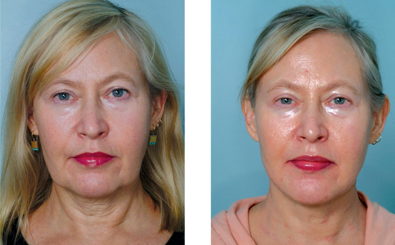 Skin Tightening Treatment in London