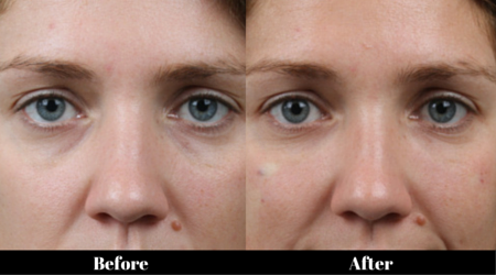 Tear Trough and Eye Bag Correction Treatment in London