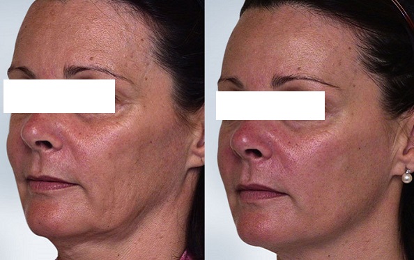 Sculptra Treatment in London