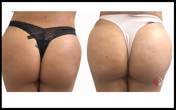 BUTT and Calf augmentation and Contouring with Hyacorp in London