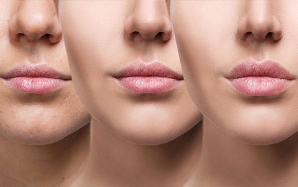 dermal fillers in london