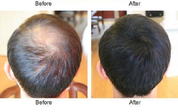 Hair Loss Treatment in London