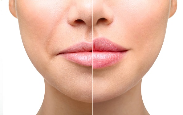 Lip Fillers in London