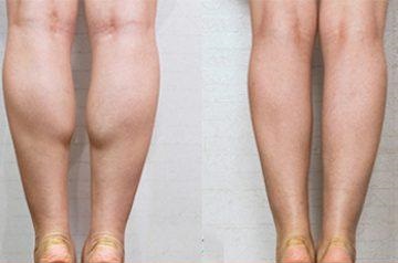 Non-Surgical Calf Reduction Treatment in London