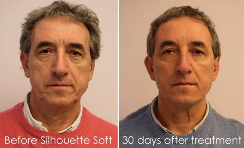 Silhouette Soft® Thread Lift in london